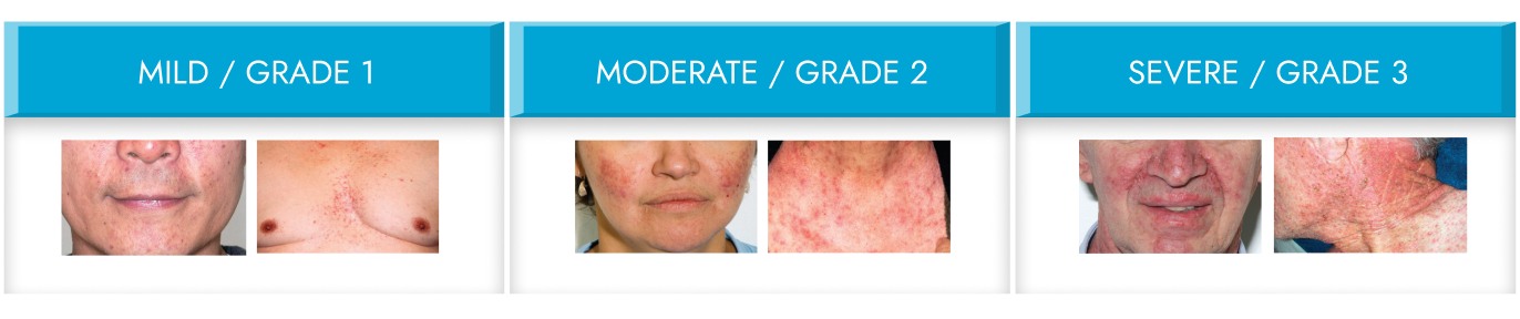 Three examples of rash intensity on the patient’s face and. The mild rash is classified as Grade 1, moderate rash is Grade 2, and severe rash is Grade 3.