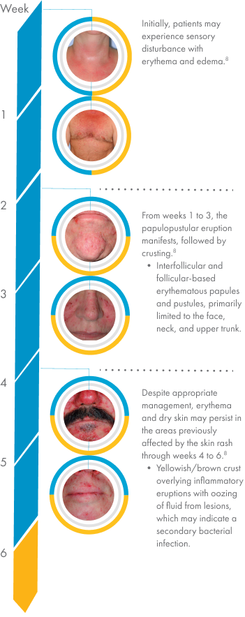 An example of skin rash development and progression due to Vectibix treatment over a 6-week period. Initially, the patient may experience generalized rash and skin swelling, but from weeks 1 to 3, the rash can erupt in papules or pustules with crusting. The pustules and papules are primarily limited to the face, neck, and upper trunk. From week 4 and beyond, the rash might persist, despite appropriate management. The rash can appear as yellowish/brown crust overlying inflammatory eruptions with oozing of fluid from lesions, which can be indicative of a secondary bacterial infection.13