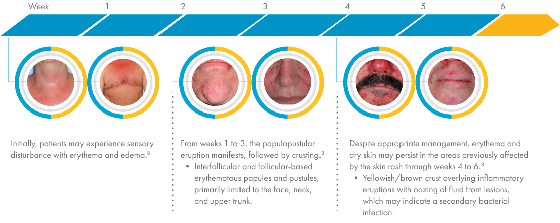 An example of skin rash development and progression due to Vectibix treatment over a 6-week period. Initially, the patient may experience generalized rash and skin swelling, but from weeks 1 to 3, the rash can erupt in papules or pustules with crusting. The pustules and papules are primarily limited to the face, neck, and upper trunk. From week 4 and beyond, the rash might persist, despite appropriate management. The rash can appear as yellowish/brown crust overlying inflammatory eruptions with oozing of fluid from lesions, which can be indicative of a secondary bacterial infection.13